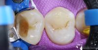 Caries Removal