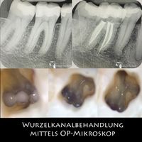 Wurzelkanalbehandlung mittels OP-Mikroskop