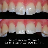 Nicht-Invasive Therapie Wieße Flecken auf den Zähnen